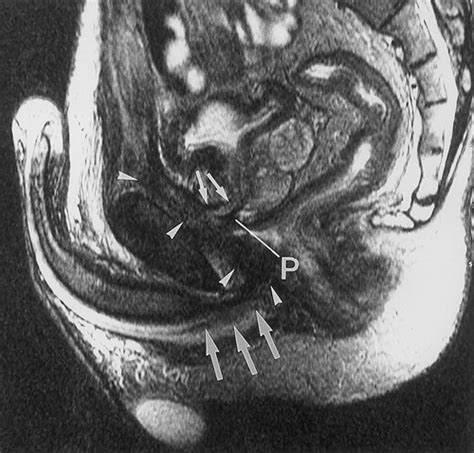 mri セックス|Magnetic resonance imaging of male and female genitals during。